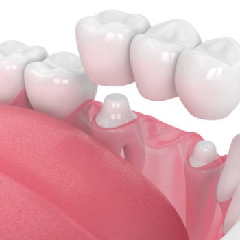 3d render of jaw with dental bridge  over white background