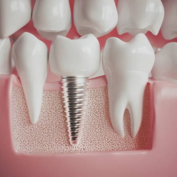 Implant next to a healthy molar -- 3D rendering