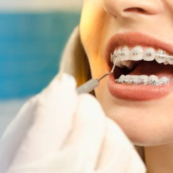 Closeup dental braces checkup , perfect white teeth with dental braces woman in half smile