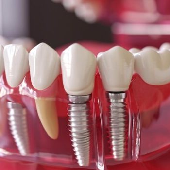 Root Canal Treatment(RCT)